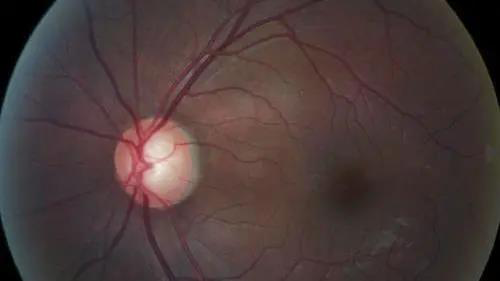 青光眼的克星来袭，助力患者远离视力的“窃贼”