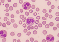 一种神秘颗粒被发现了！它能否成为败血症早筛标志物？