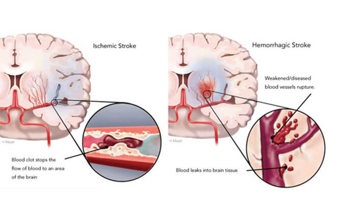 世界卒中日：从动物药效模型评价看心脑血管药物开发
